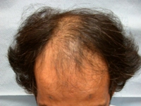 طلب كبير على عمليات زراعة الشعر في الشرق الأوسط والخليج
